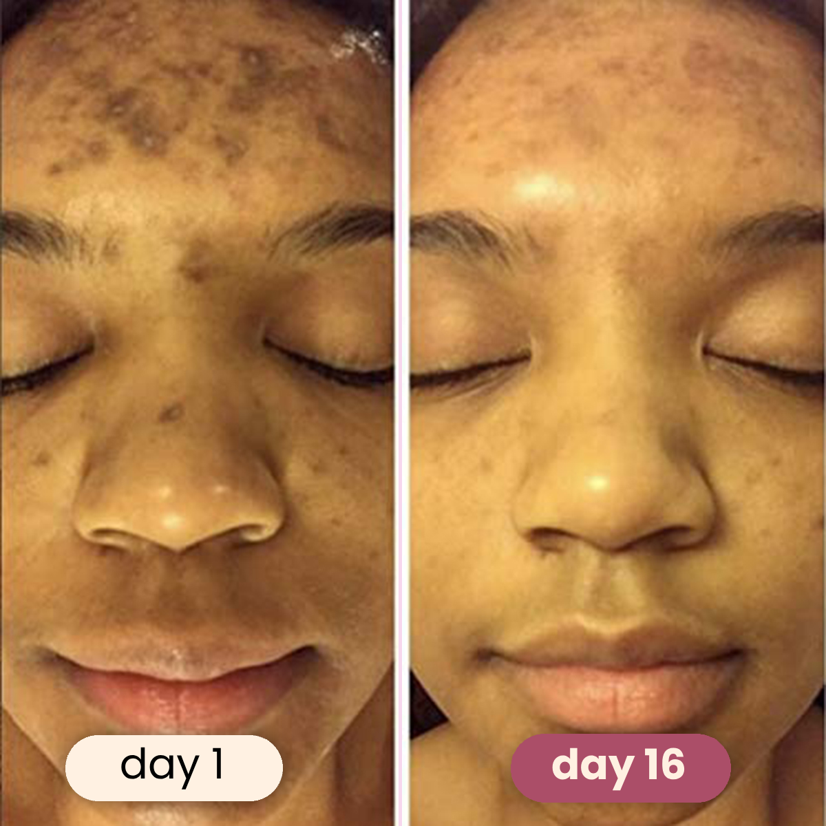 Brightening turmeric & kojic acid pads